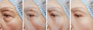 Old woman wrinkles before and after collage correction regeneration treatments