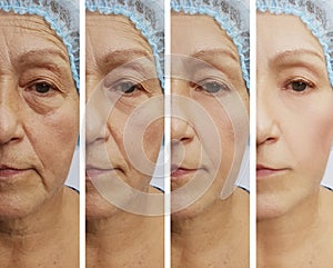 Old woman wrinkles before and after collage regeneration treatments