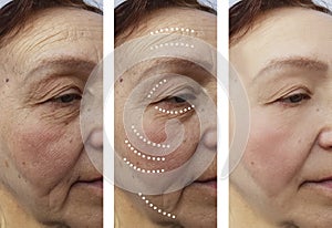 Old woman wrinkles correction difference before and after treatments