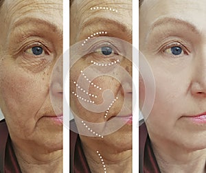Old woman wrinkles correction result difference difference before and after treatments lifting