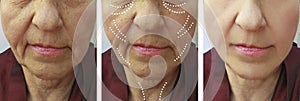 Old woman wrinkles correction result difference removal difference before and after treatments lifting