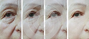 Old woman wrinkles eyes before and after result correction treatment