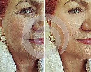 Old woman wrinkles face lift beautician before and effect correction after treatment