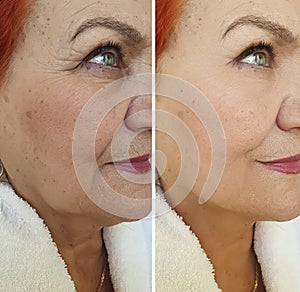 Old woman wrinkles face before and after treatment