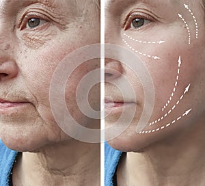 Old woman wrinkles before and lifting after results medicine procedures, facial