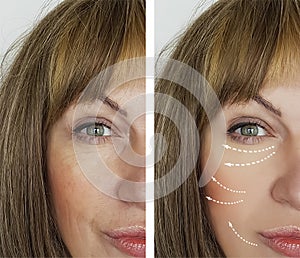 Old woman wrinkles before results beautician treatment lifting after regeneration results medicine procedures, facial