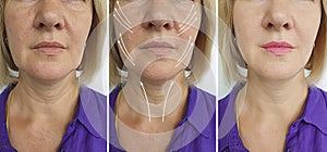 Old woman wrinkles tightening arrow sagging correction before after lifting plastic filler