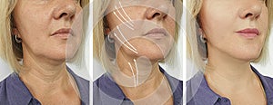 Old woman wrinkles tightening arrow sagging  effect  correction before after lifting plastic filler