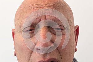 Older man close view of face with anxious pain, bald, alopecia, chemotherapy, cancer, isolated on white