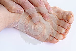 An older woman has itchy and dry skin on her hands and feet