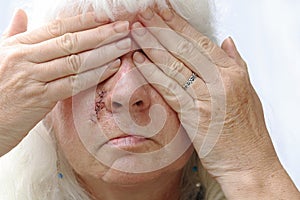 An older woman has a scar on her face and is ashamed of it