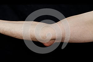 Olecranon bursitis, also known as studentâ€™s elbow