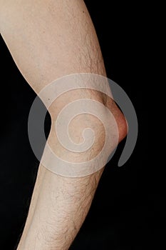 Olecranon bursitis, also known as studentâ€™s elbow