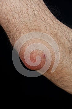 Olecranon bursitis, also known as studentâ€™s elbow