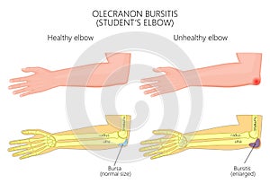 Olecranon bursitis or student's elbow