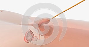 Once inside the urethra, the catheter is continued to advance toward the bladder