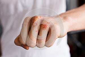 One Caucasian man hand with psoriasis on a white background. Problematic eczema skin. Dermatology and medicine photo photo