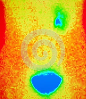 One kidney , nuclear medicine