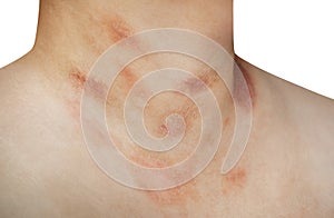 One person with Pityriasis rosea disease on the chest and neck