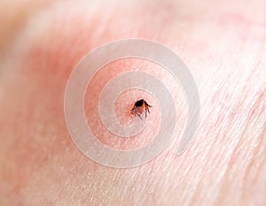 A tick embedded in a person skin. photo