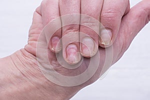 Onycholysis isolated on white background. Mechanical damage to the nail plate.