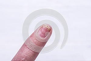 Onycholysis isolated on white background. Mechanical damage to the nail plate. photo