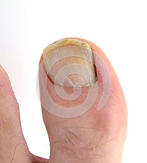Onychomycosis on the first toe. photo