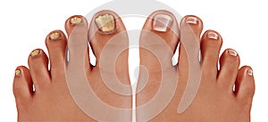 Onychomycosis Foot disease photo
