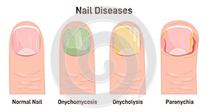 Onychomycosis, onycholysis, paronychia. Nail diseases, nail fungal