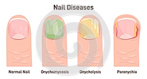 Onychomycosis, onycholysis, paronychia. Nail diseases, nail fungal photo