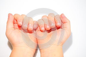 Onychophagia bitten nails in a child