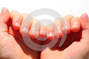 Onychophagia bitten nails in a child