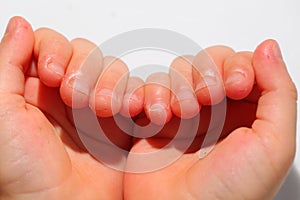 Onychophagia bitten nails in a child