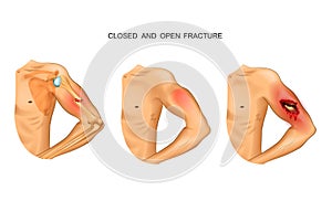 Open and closed fracture photo