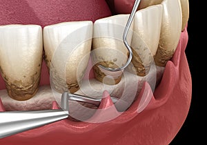 Open curettage: Scaling and root planing conventional periodontal therapy. Medically accurate 3D illustration of human teeth