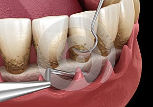 Open curettage: Scaling and root planing conventional periodontal therapy. Medically accurate 3D illustration of human teeth photo