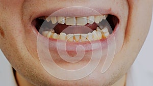 Open man`s mouth with crooked or curves yellow teeth due to smoking