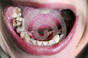 Open mouth with broken, diseased teeth affected by caries and periodontitis. Steel pin in the gum for the installation of a dental