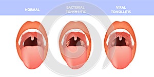 Open mouth, normal and Tonsillitis bacterial and viral. Angina, pharyngitis and tonsillitis. Infection of tonsils photo
