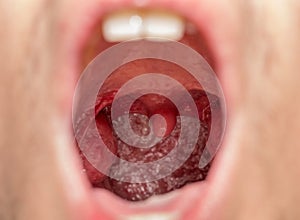 Open mouth view of tonsils