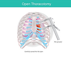 Open Thoracotomy. Infographic.