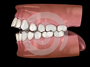 Openbite dental occlusion  Malocclusion of teeth . Medically accurate tooth 3D illustration photo
