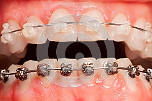Opened mouth with ceramic and metal braces photo