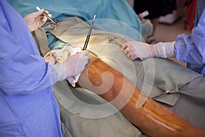 Operation of varicose veins