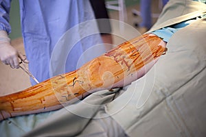 Operation of varicose veins in operating room