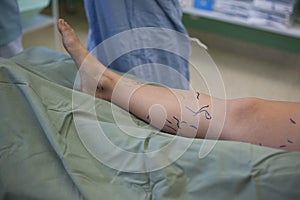 Operation of varicose veins in operating room