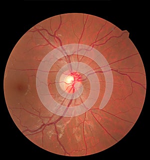 Ophthalmic image detailing the retina and optic nerve inside a healthy human eye. Health protection concept
