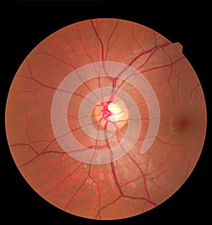 Ophthalmic image detailing the retina and optic nerve inside a healthy human eye. Health protection concept photo