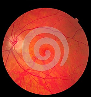 Ophthalmic image detailing the retina and optic nerve inside a healthy human eye. Medicine concept photo