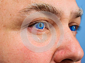 Ophthalmologist concept. Mans eye with contact lens, closeup. Man with blue eyes